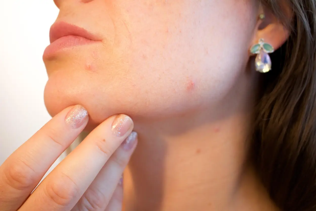Long-Term Psoriasis Relief May Be as Simple as a Daily Pill